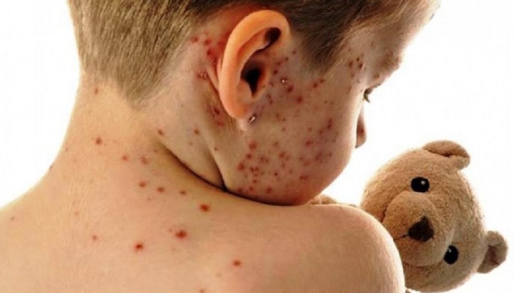 Epidemija ospica u BiH, za manje od mjesec dana cijepljeno više od 3 tisuće djece